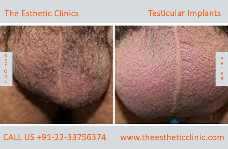 Testicular Implant surgery before after photos in mumbai india (3)
